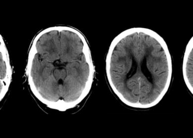 CADASIL: Arteriopatía cerebral autosómica dominante con infartos subcorticales y leucoencefalopatía